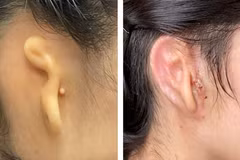 Tai của một bệnh nhân trước khi phẫu thuật (trái) và 30 ngày sau khi phẫu thuật. (Nguồn: NYtimes)