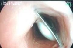 Hình ảnh nội soi gắp dị vật cho bệnh nhân. (Ảnh: TTXVN phát)