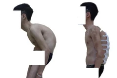 Ảnh chụp nghiêng bệnh nhân trước và sau phẫu thuật. (Nguồn: benhvien108.vn)