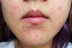 Những biện pháp giúp xử lý làn da bị kích ứng nghiêm trọng