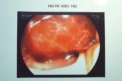 Hình ảnh nội soi trước phẫu thuật. (Ảnh: TTXVN)