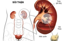Sỏi niệu quả, do sỏi thận rơi xuống niệu quản rồi bị giữ lại ở đó, có thể gây ứ nước ở thận. (Nguồn: Internet)