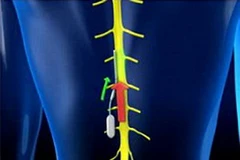 Chip thông minh INS2 có thể được cấy ghép trực tiếp vào cạnh cột sống. (Nguồn: dailymail.co.uk)