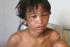 Tỷ lệ thương tật của cháu Hào Anh là 66,83%. (Ảnh: Điệp Hồng/TTXVN)