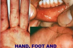 Các biểu hiện của bệnh tay-chân-miệng. (Nguồn: Internet)