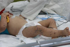 Cà Mau: Hai bệnh nhi tử vong do sốt xuất huyết và tay chân miệng