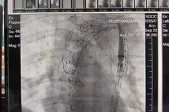 Can thiệp, phẫu thuật điều trị bóc tách động mạch chủ ngực. (Ảnh: Mai Trang/TTXVN)