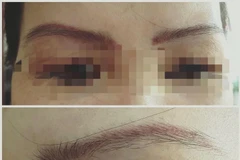 ​Chẩn đoán ban đầu trong vụ một phụ nữ tử vong sau xăm chân mày