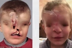 Yahya trước và sau khi phẫu thuật. (Nguồn: Dailymail)