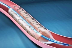 Đặt stent điều trị đột quỵ do tắc nghẽn động mạch