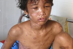 Cháu Nguyễn Hào Anh bị đa chấn thương do bị hành hạ, đánh đập dã man. (Ảnh: Điệp Hồng/TTXVN)