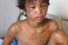 Cháu Nguyễn Hào Anh bị đa chấn thương do bị hành hạ, đánh đập dã man. (Ảnh: Điệp Hồng/TTXVN)