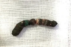 Chuỗi 7 viên bi nam châm được lấy ra từ bụng bé gái. (Nguồn: suckhoedoisong.vn)