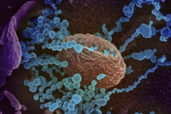 Hình ảnh quét qua kính hiển vi điện tử cho thấy virus SARS-CoV-2 (vật thể tròn màu xanh) nổi lên trên bề mặt tế bào bệnh nhân nhiễm COVID-19. (Nguồn: AFP/TTXVN)