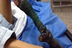 Đau lòng với hình ảnh cô gái có chân teo quắt do bị rắn cắn 