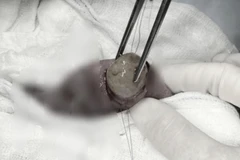 Bác sỹ gắp dị vật hạt nở. (Ảnh: Đinh Hằng/TTXVN)