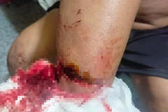 Một người dân bị thương khi chống trả bọn cướp. 