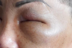 Tình trạng sưng, phù nề của một bệnh nhân tiêm filler khi nhập viện. (Ảnh do bệnh viện cung cấp)