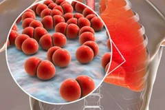 Phế cầu khuẩn là nguyên nhân gây ra khoảng 1,6 triệu ca tử vong trên toàn thế giới mỗi năm. (Nguồn: Plenglish)