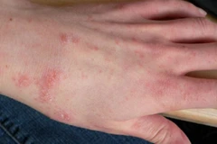 Biểu hiện của bệnh ghẻ. 