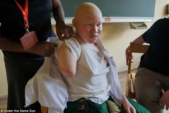 Đau xót hình ảnh cô gái bạch tạng bị chặt tay để làm thuốc phù thủy