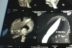 Hình ảnh chụp X-quang. (Ảnh do bệnh viện cung cấp)