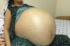 Bệnh nhân Đ.T.T với khối u khổng lồ trước phẫu thuật. (Ảnh:TTXVN/phát)