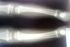 Phát minh mới giúp tái tạo xương từ mỡ hoặc chất béo