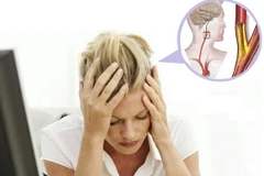 Đau đầu là triệu chứng rối loạn hoạt động não bộ, tăng nguy cơ đột quỵ.