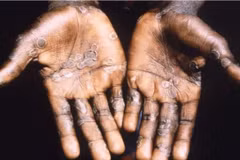 Một bệnh nhân mắc đậu mùa khỉ được điều trị tại trung tâm y tế ở Lodja, CHDC Congo. (Ảnh: Reuters/TTXVN)