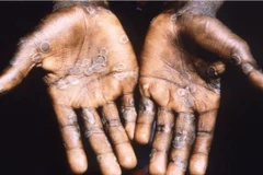 Một bệnh nhân mắc đậu mùa khỉ được điều trị tại trung tâm y tế ở Lodja, CHDC Congo. (Ảnh: Reuters/TTXVN)