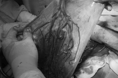 Hình ảnh dây rốn bám màng. (Ảnh: TTXVN phát)