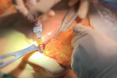 Êkíp bác sỹ Bệnh viện thẩm mỹ JW đưa khối silicon ra khỏi ngực phải bệnh nhân. (Ảnh: TTXVN phát)