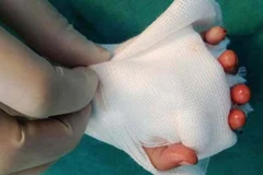 Cấp cứu kịp thời ngư dân bị đứt rời đốt ngón tay, mất nhiều máu