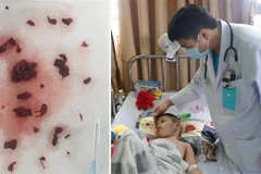 Hình ảnh các cục huyết khối được lấy ra khỏi tĩnh mạch não của bệnh nhi. (Ảnh: TTXVN phát) 