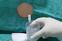 Các bác sỹ chọc dò dịch não tủy làm xét nghiệm đánh giá tình trạng viêm não màng não bệnh nhân. 