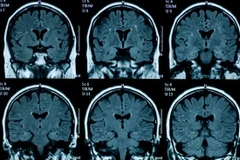 ​Sức khỏe tâm thần giảm sút đi đôi với những thay đổi về cấu tạo vật lý của não bộ ở thiếu niên. (Nguồn: Getty Images)