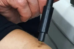 Biện pháp mới này sẽ cách mạng hóa việc chẩn đoán ung thư da. (Nguồn: Đại học Tel Aviv)