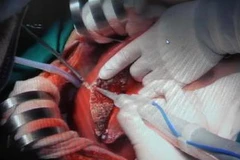 Các bác sĩ thực hiện đang thực hiện ca phẫu thuật. (Ảnh: Phương Vy/TTXVN)