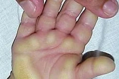 Hội chứng viêm da dày sừng bàn tay bàn chân. 