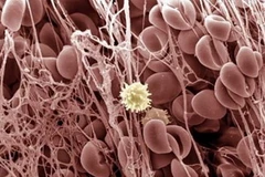 Hình ảnh một cục máu đông trông như một mạng nhện dính chùm nhiều hồng huyết cầu với nhau. (Nguồn: Internet)