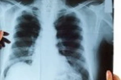 U trung biểu mô màng phổi. (Nguồn: Internet)