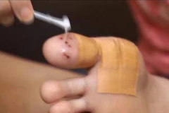 Một trường hợp nhiễm HPV hiếm gặp ở Singapore. (Nguồn: Channel NewsAsia)