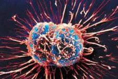 Tế bào ung thư. (Nguồn: Internet)