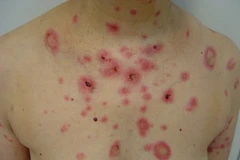 Một bệnh nhân bị lupus ban đỏ. (Nguồn: Initernet)