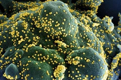 Một tế bào (xanh dương/xanh lục) bị nhiễm nặng các hạt virus SARS-CoV-2 (màu vàng), được phân lập từ mẫu của bệnh nhân COVID-19. (Ảnh: AFP/TTXVN)