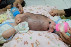 Hai bé gái bị dính đầu đáng thương. (Nguồn: Carter News)