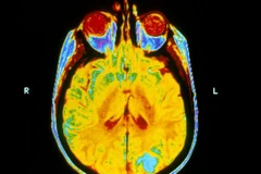 Xạ trị não bộ không giúp chữa trị căn bệnh ung thư phổi di căn