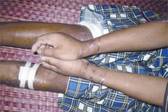 Những vết sẹo trên thân thể Hào Anh do vợ chồng Giang gây nên. (Ảnh: Internet)