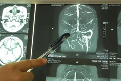 Hình ảnh mạch máu não của bệnh nhân Trần Thị Th. bị tắc nghẽn. (Ảnh: TTXVN phát)